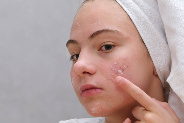 Clinical Acne Management Guide | iS Clinical vs ZO Skin Health
