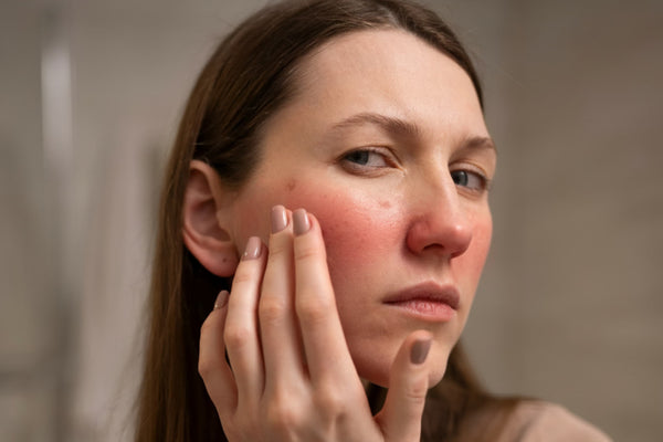 Rosacea Skincare Guide: Causes, Triggers & Best Products