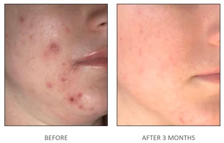 Guide de gestion clinique de l’acné | iS Clinical vs ZO Skin Health