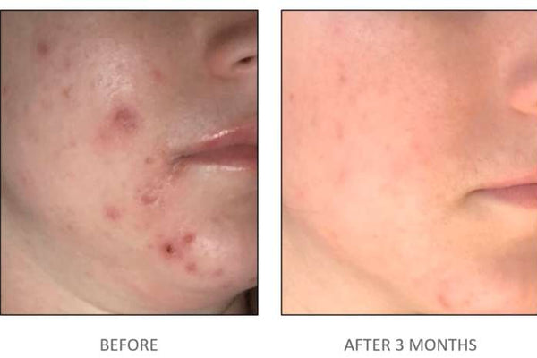 Guide de gestion clinique de l’acné | iS Clinical vs ZO Skin Health