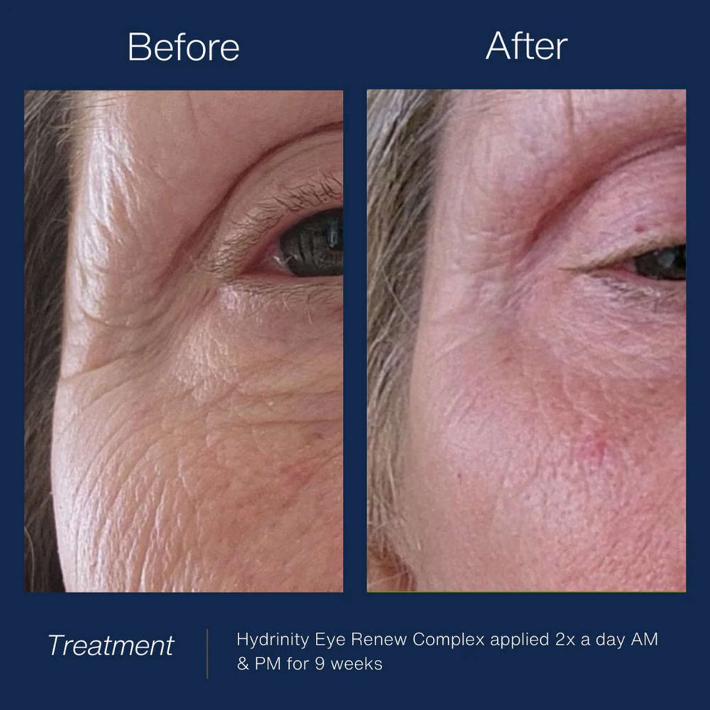 Hydrinity Reye Complex Hydrinity Eye Renew Complex | Dark Circle & Anti-Aging Eye Treatment