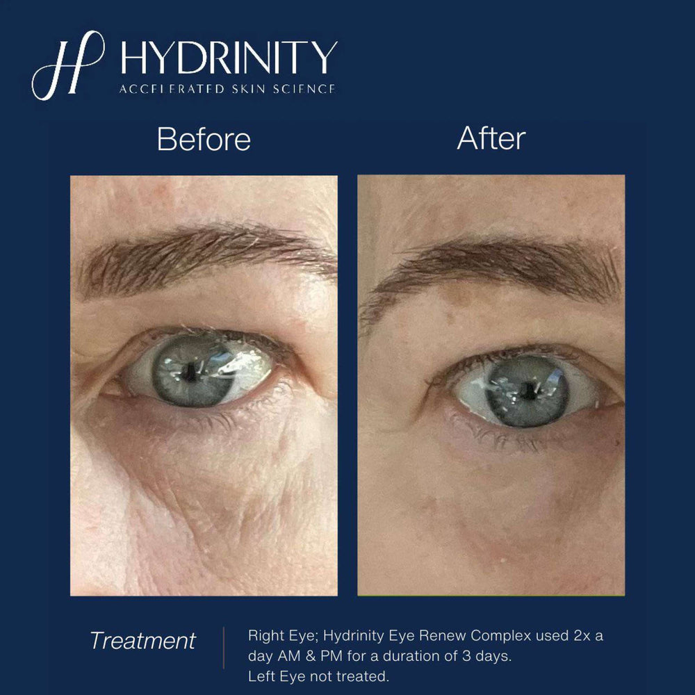 Hydrinity Reye Complex Hydrinity Eye Renew Complex | Dark Circle & Anti-Aging Eye Treatment