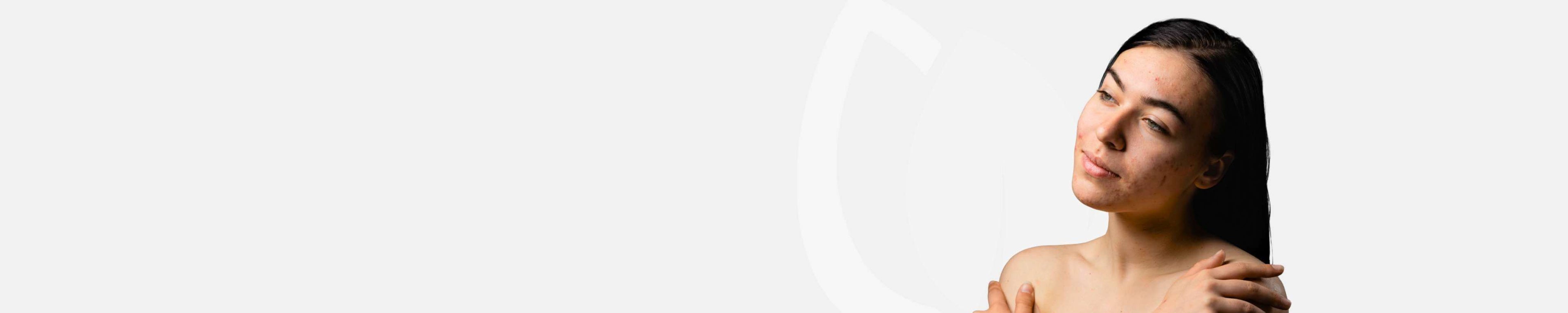 Peau sujette à l’acné