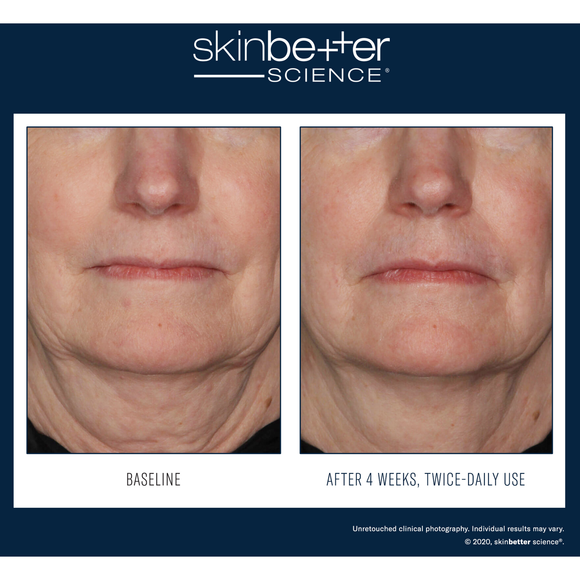 SkinBetter InterFuse® visage et cou
